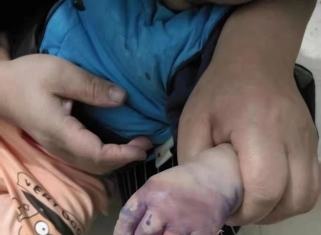 擦伤，烧烫伤无疤痕修复皮肤