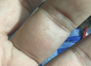 皮下小圆点